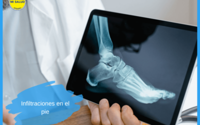 Infiltraciones en el pie: todo lo que necesitas saber