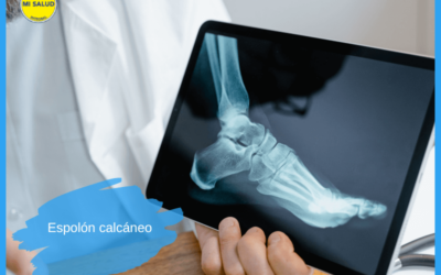 Espolón calcáneo: qué es, causas, síntomas y tratamientos